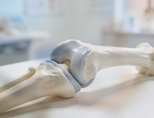 Arthrosebehandlung